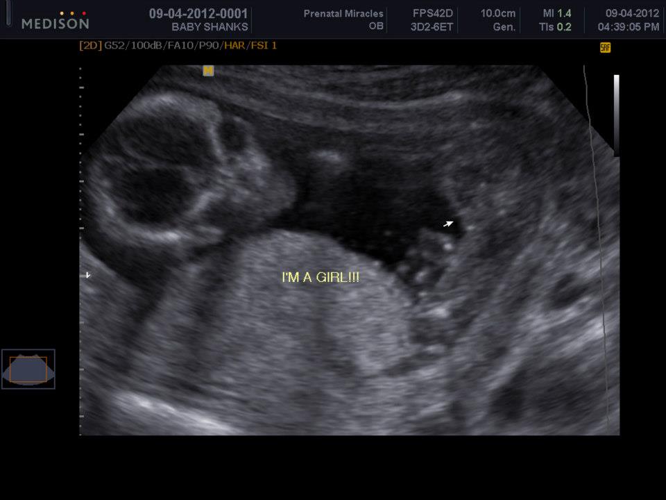 Girl ultrasound